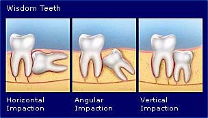 wisdom teeth impacted root canal treatment removal